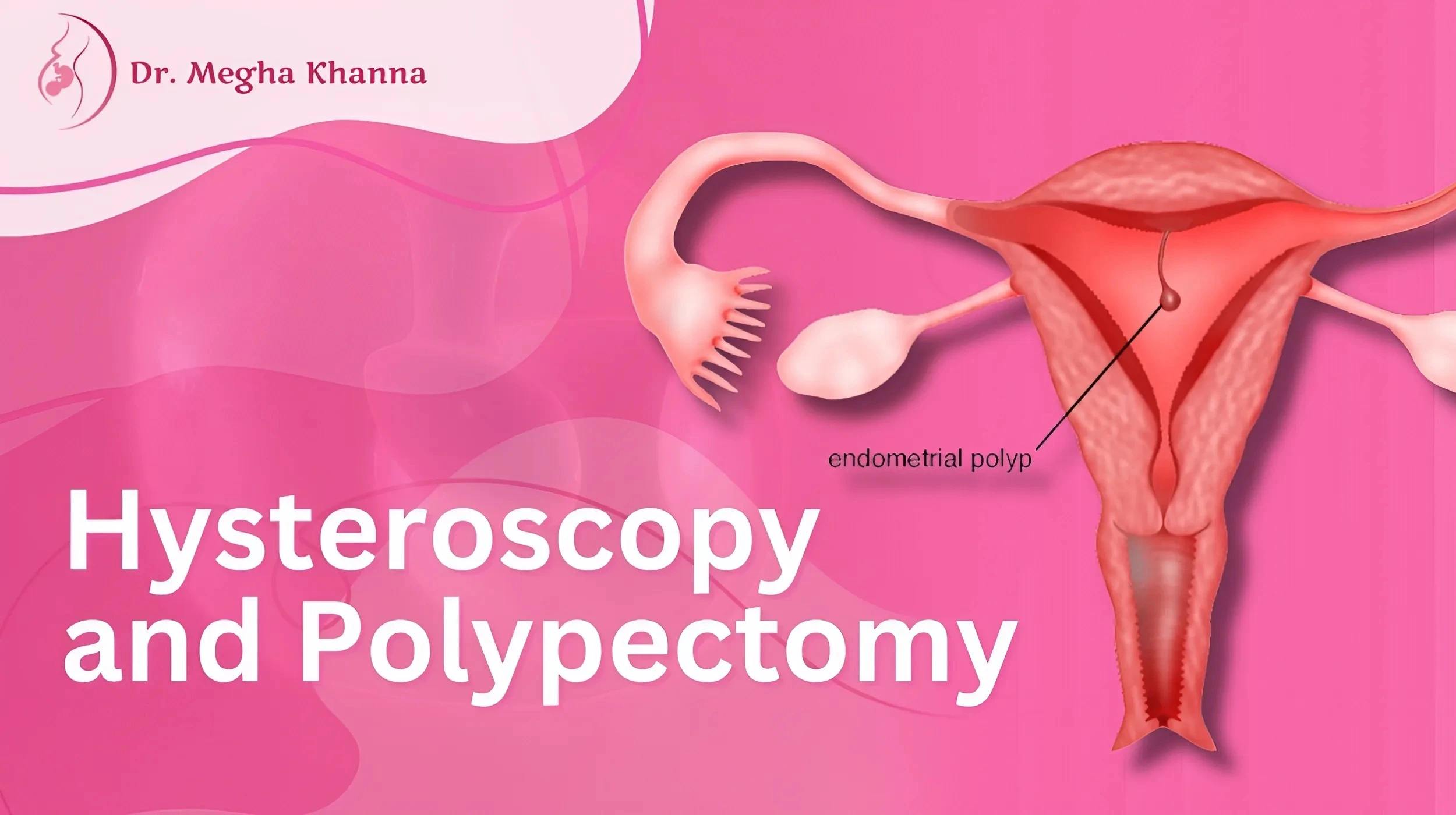 hysteroscopy and polypectomy